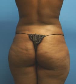 Brazilian Butt Lift Before - Patient 203156