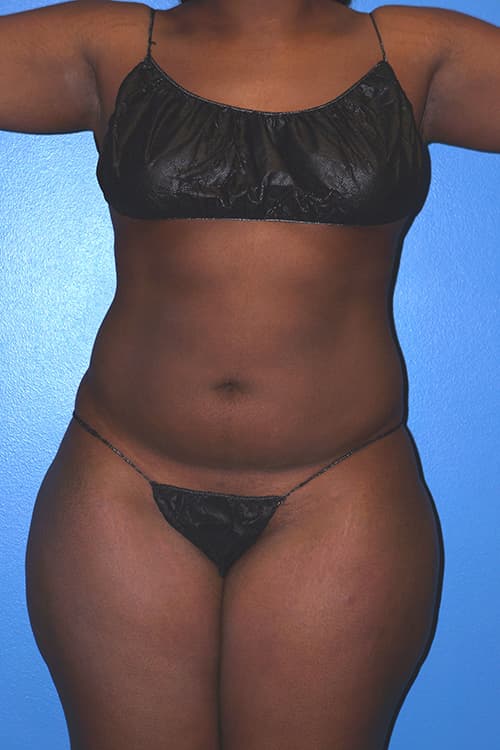 Brazilian Butt Lift Before - Patient 203156 - Front View