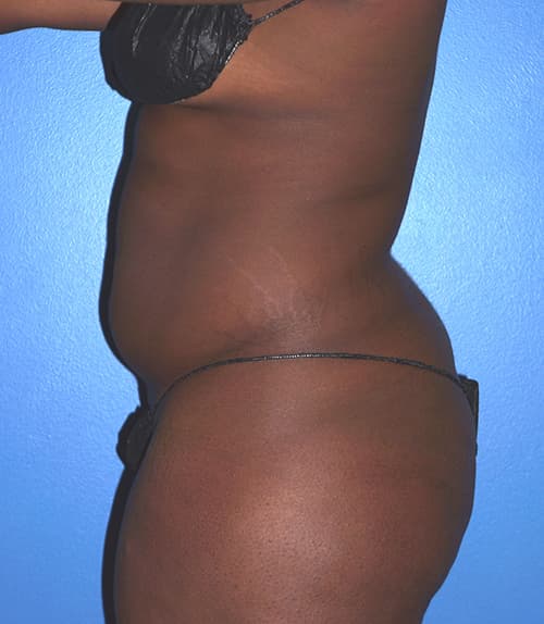 Brazilian Butt Lift Before - Patient 203156 - Left View