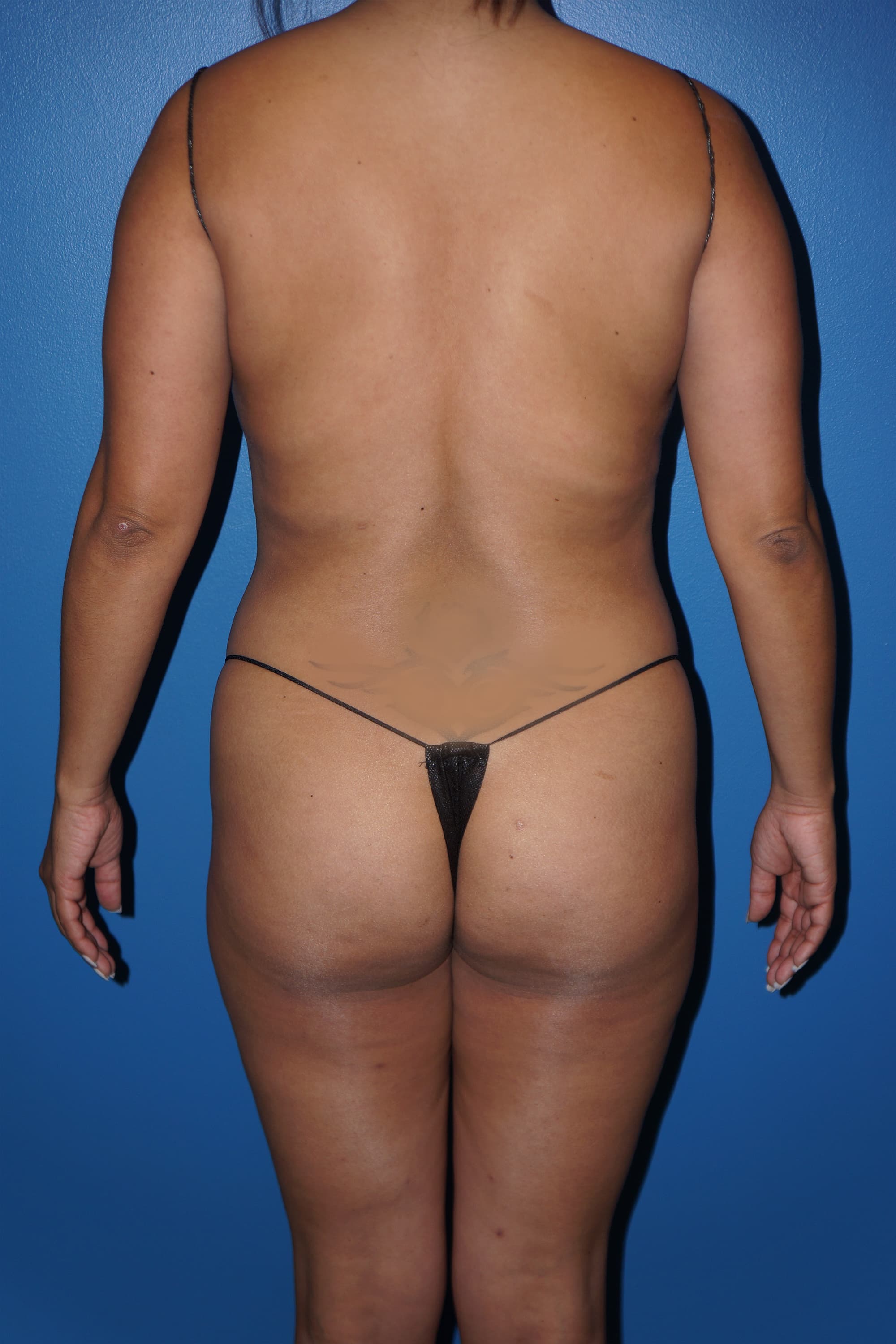 Brazilian Butt Lift Before - Patient 248321 - Back View