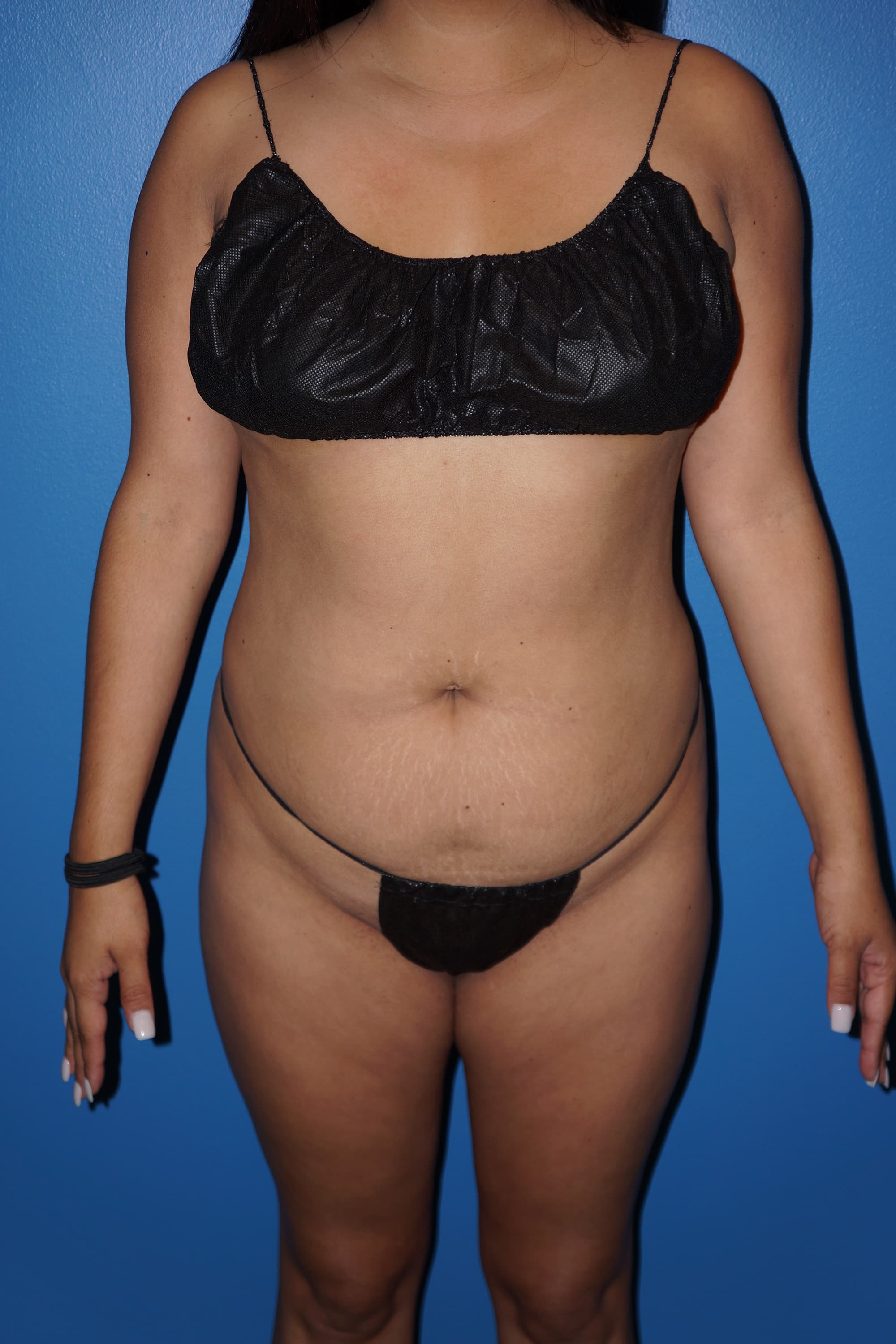 Brazilian Butt Lift Before - Patient 248321 - Front View