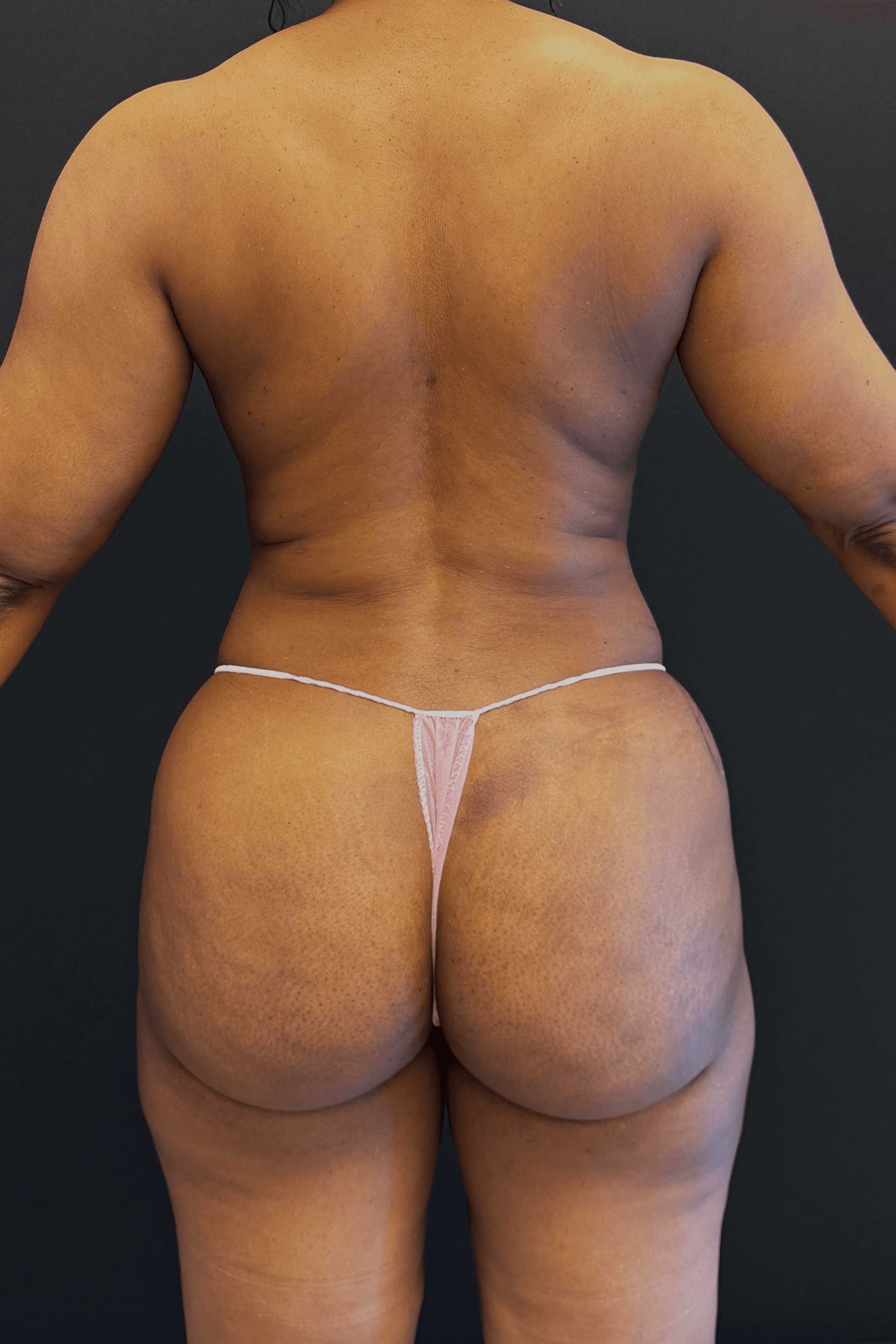 High-Definition Liposuction 360 After - Patient 156318 - Back View