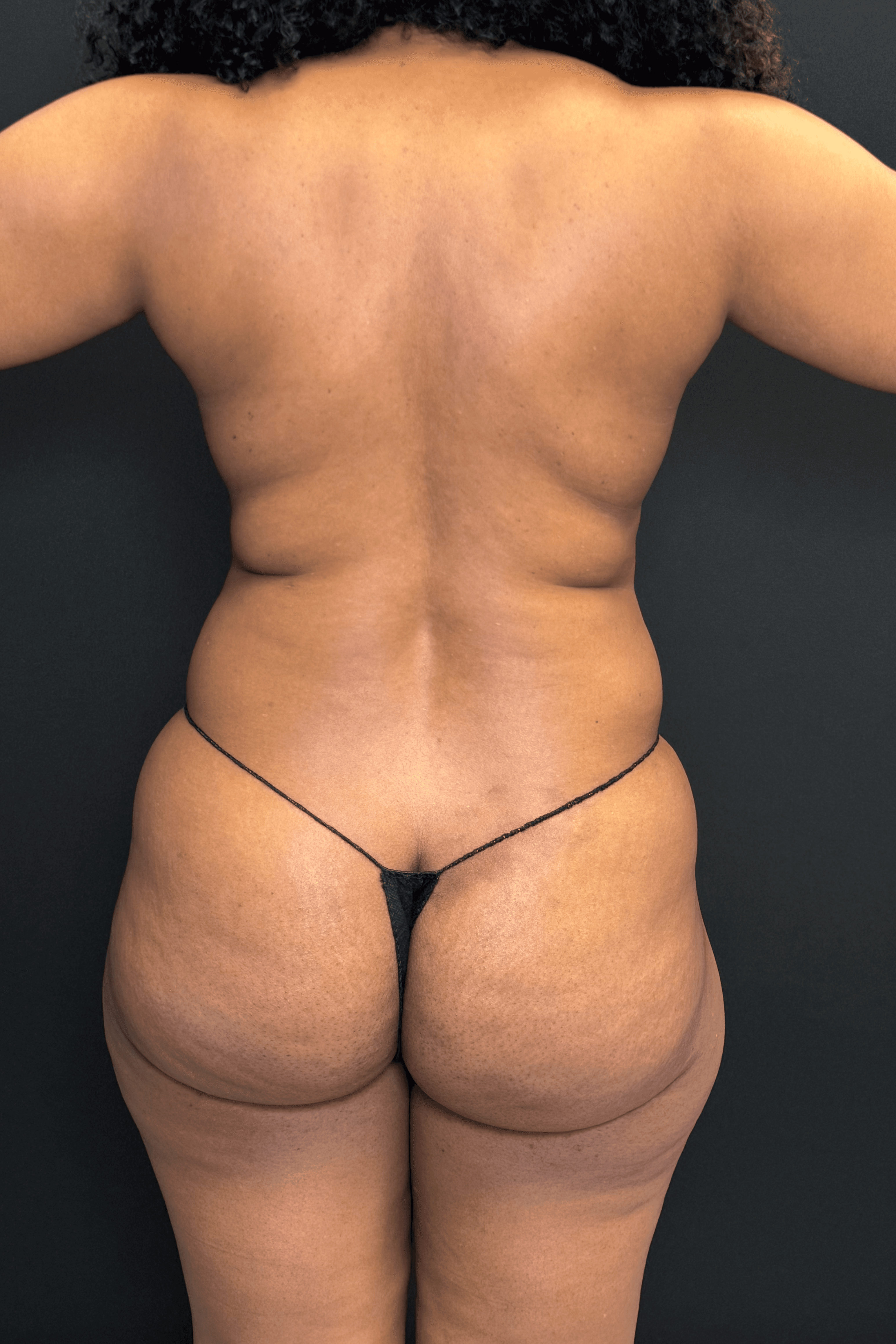 High-Definition Liposuction 360 Before - Patient 156318 - Back View