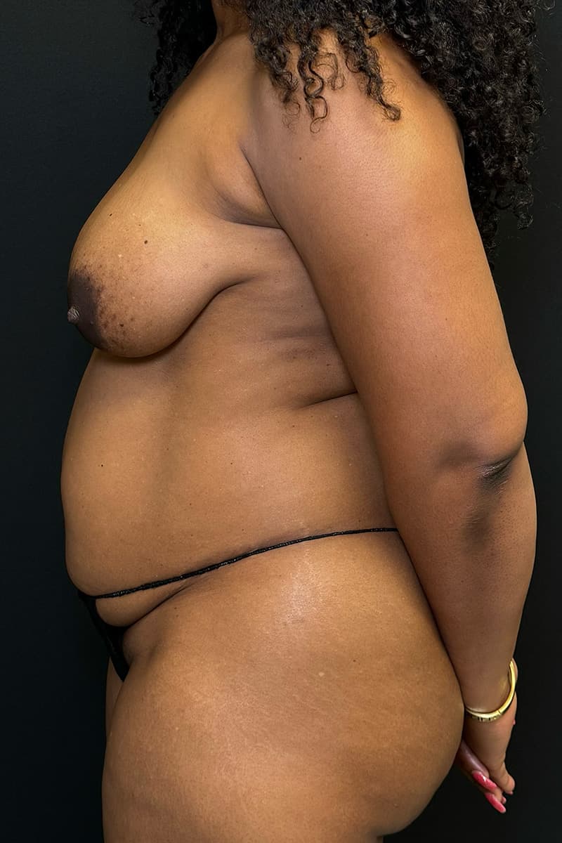 High-Definition Liposuction 360 Before - Patient 156318 - Left 2 View