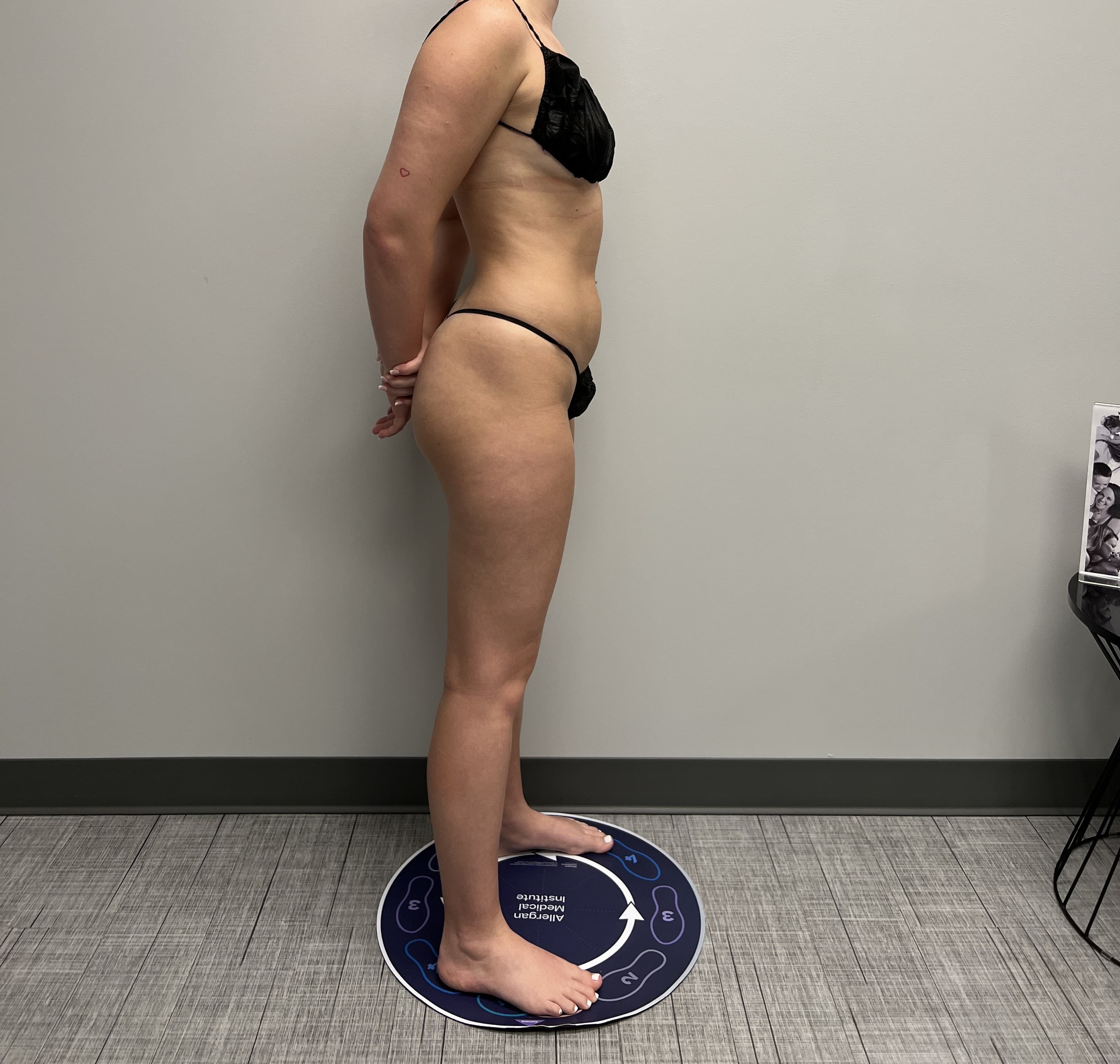 High-Definition Liposuction 360 Before - Patient 3461 - Right View