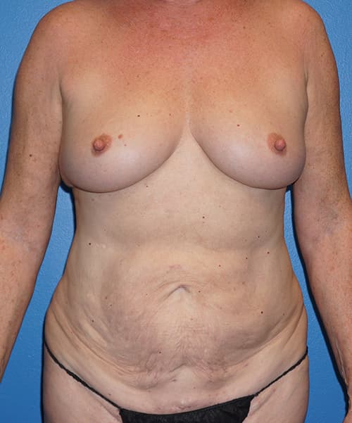 Mommy Makeover Before - Patient 93894345