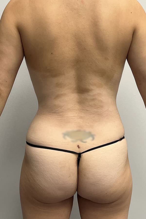 Mommy Makeover After - Patient 182661 - Back View
