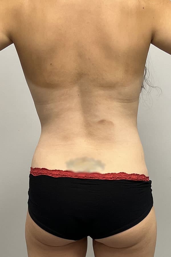 Mommy Makeover Before - Patient 182661 - Back View