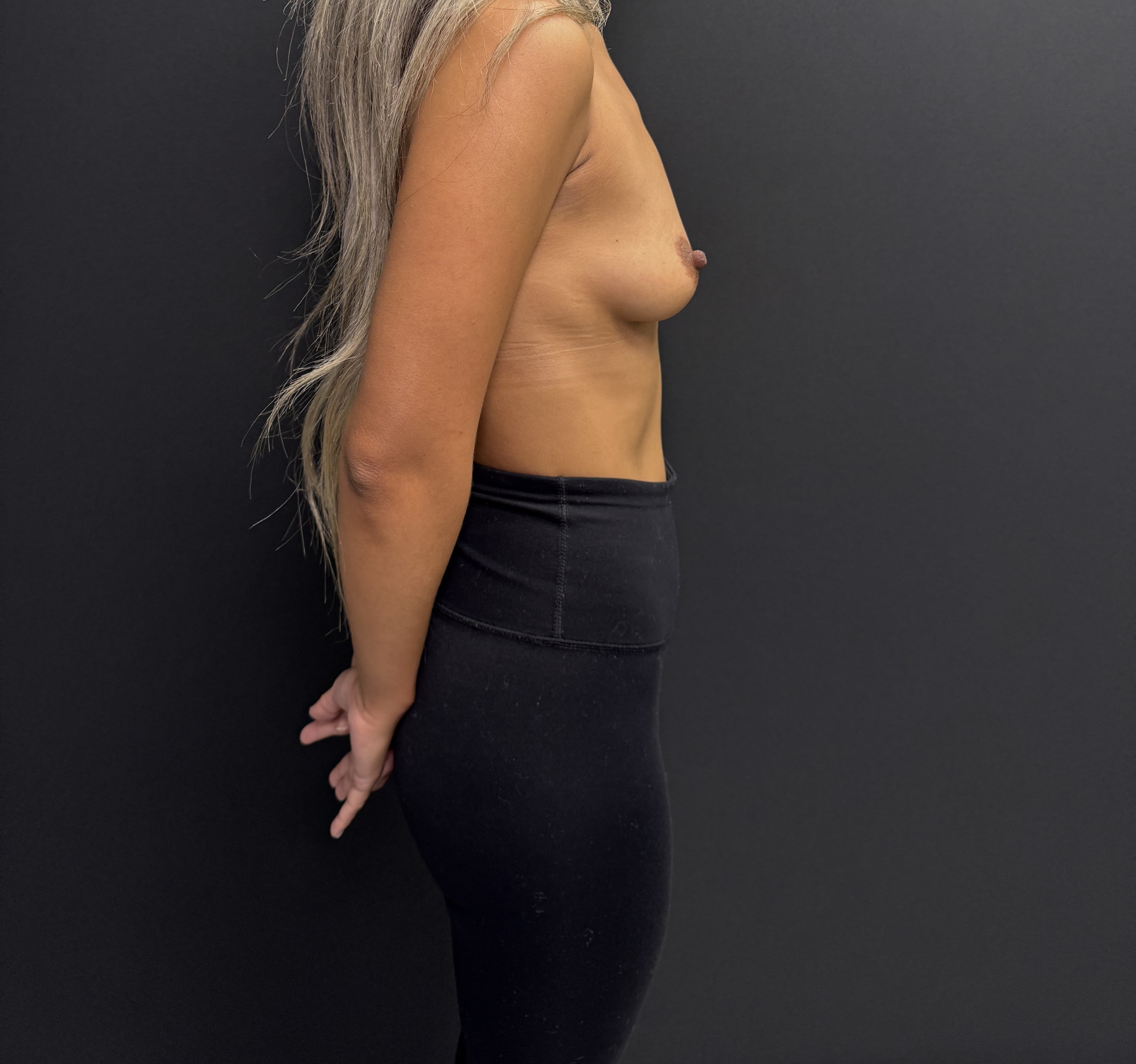 Breast Augmentation Before - Patient 4940 - Right View