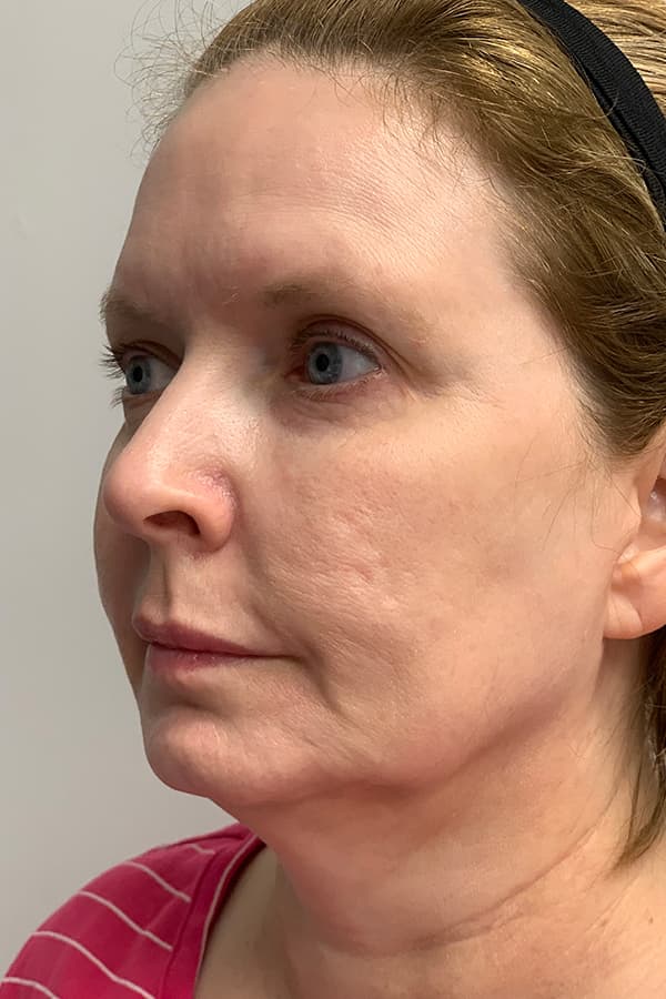 Contour TRL After - Patient 93894534 - Front Left View