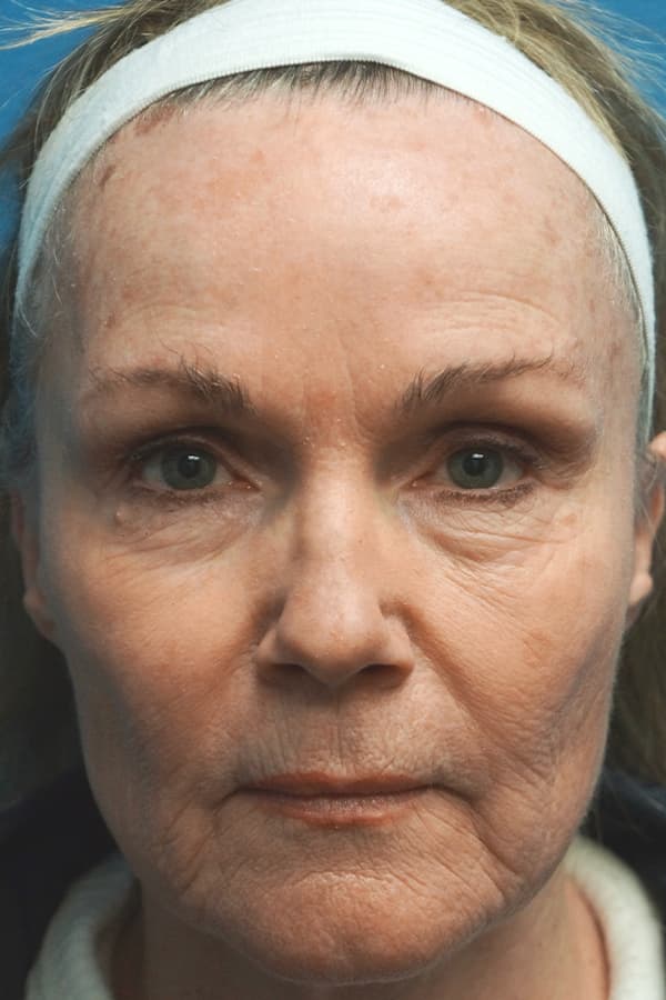 Contour TRL Before - Patient 93894543 - Front View