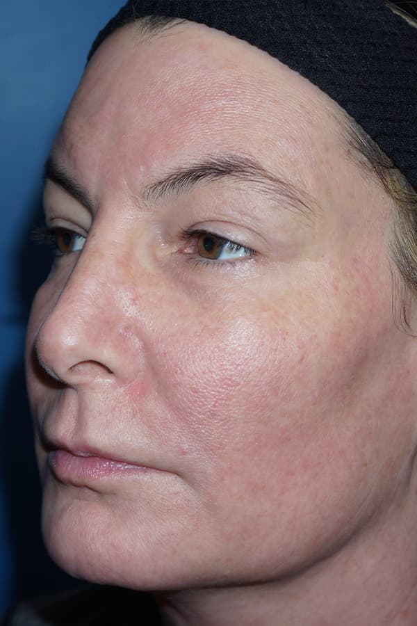 Contour TRL After - Patient 93894559 - Front View