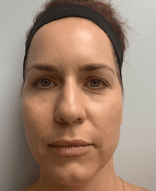 Halo Laser After - Patient 93894399 - Front View