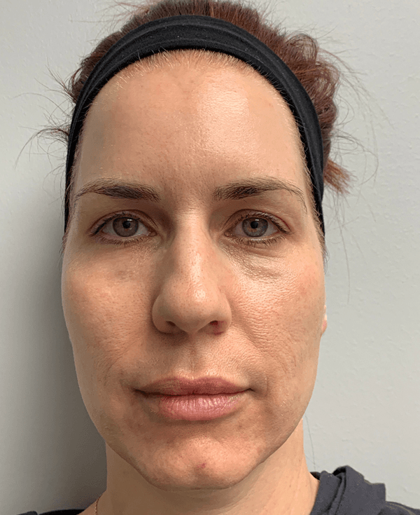 Halo Laser Before - Patient 93894399 - Front View