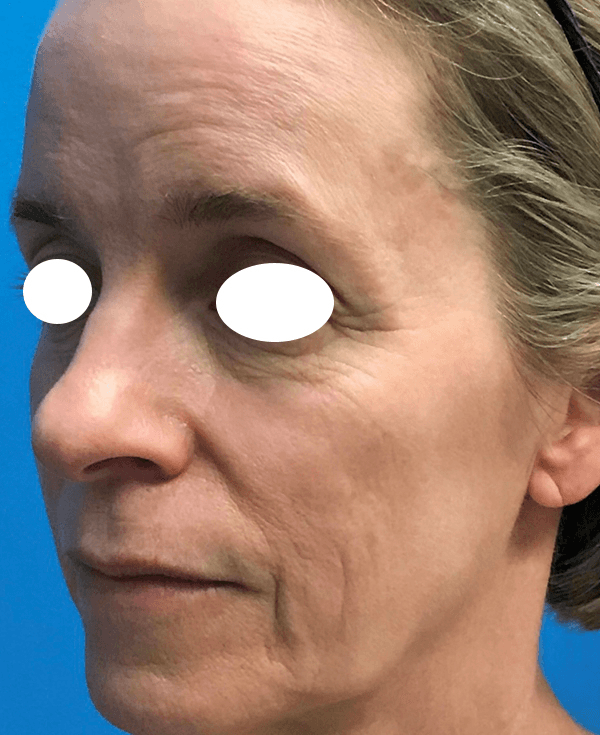 Halo Laser Before - Patient 93894414 - Front View