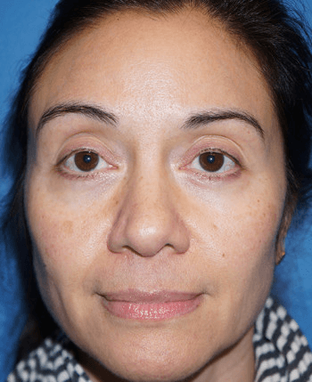 Halo Laser After - Patient 93894399 - Front View