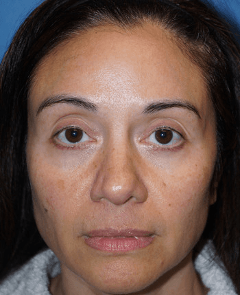 Halo Laser Before - Patient 93894399 - Front View