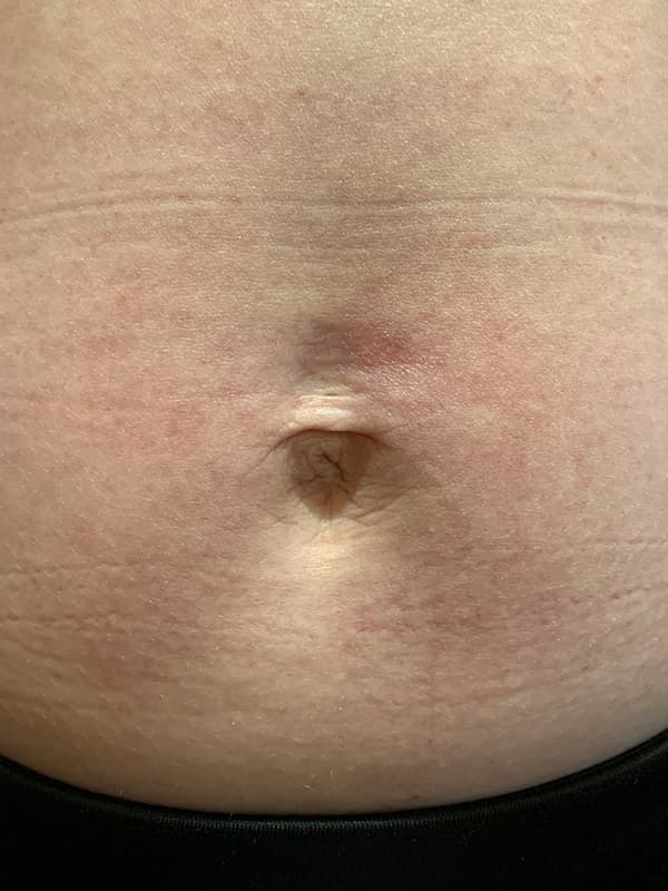 Halo Laser After - Patient 93894557 - Front View