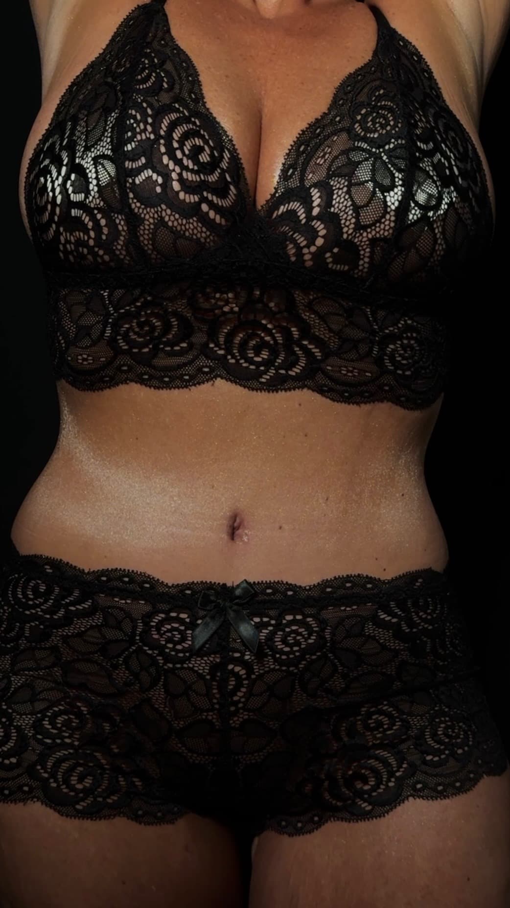 Real Tummy Tuck patient results
