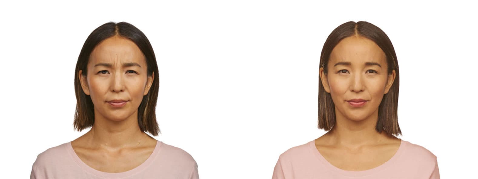 Jeuveau Before & After