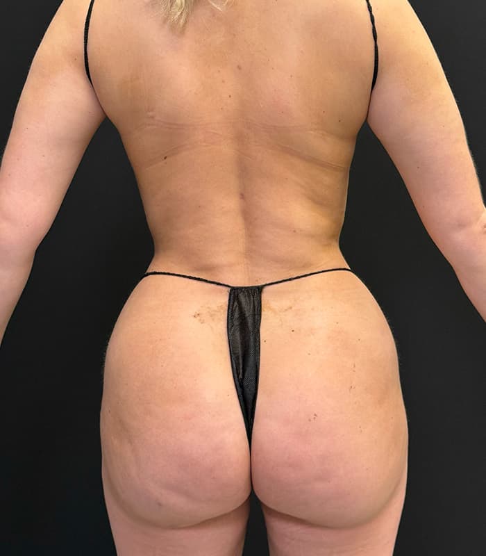 High-Definition Liposuction 360 After - Patient 351080 - Back View