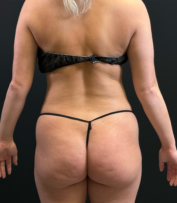 Brazilian Butt Lift Before - Patient 351080 - Back View