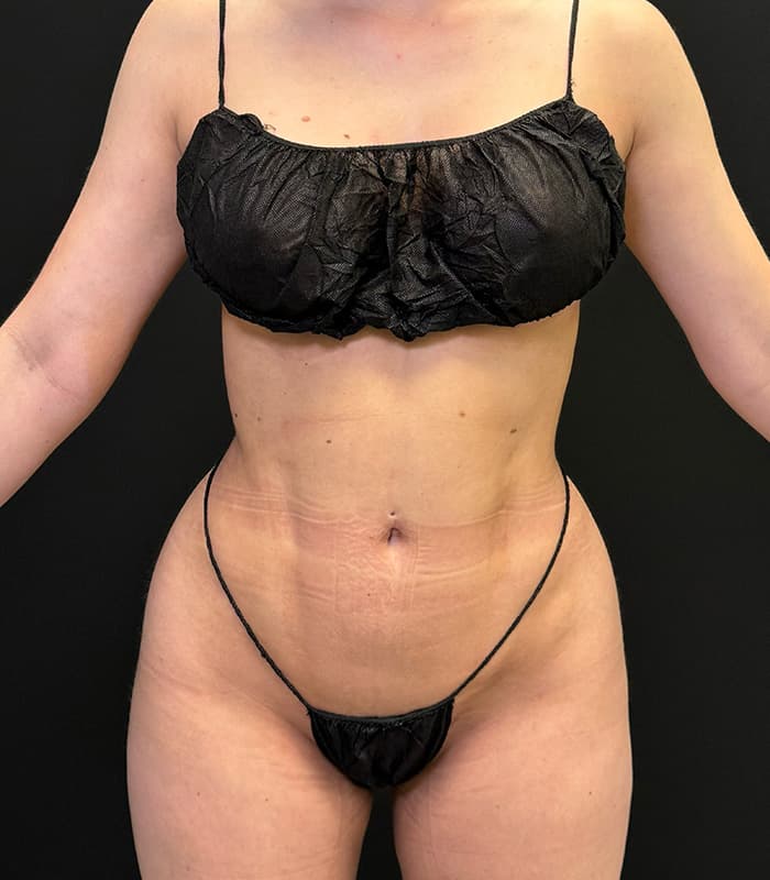 High-Definition Liposuction 360 After - Patient 351080 - Front View