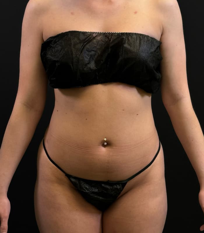 High-Definition Liposuction 360 Before - Patient 351080 - Front View