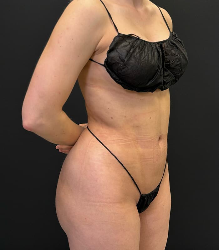 High-Definition Liposuction 360 After - Patient 351080 - Front Right View