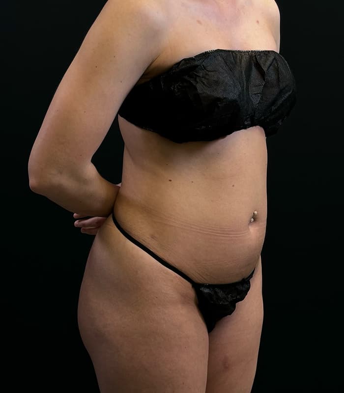 Brazilian Butt Lift Before - Patient 351080 - Front Right View