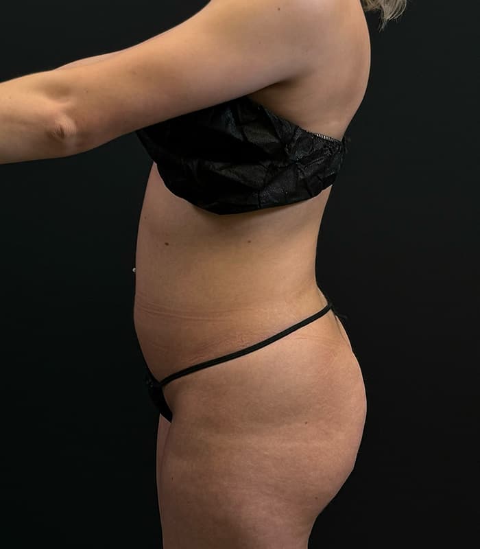 High-Definition Liposuction 360 Before - Patient 351080 - Left View