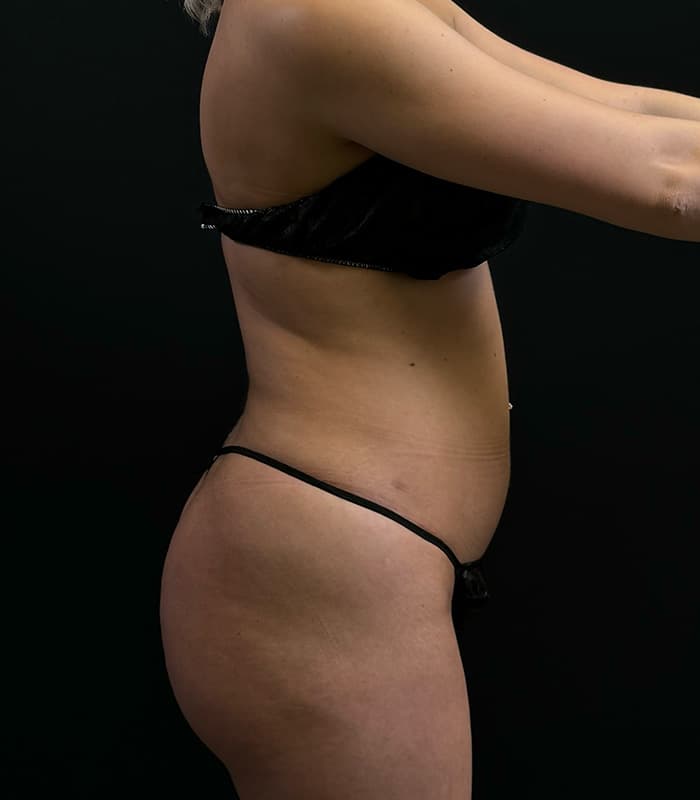 Brazilian Butt Lift Before - Patient 351080 - Right View