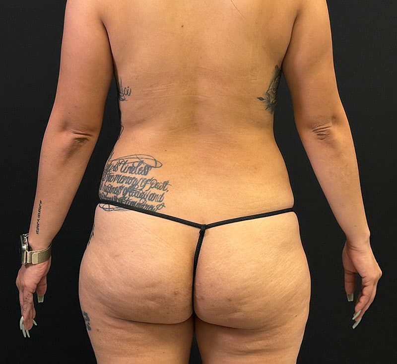 High-Definition Liposuction 360 Before - Patient 423426 - Back View