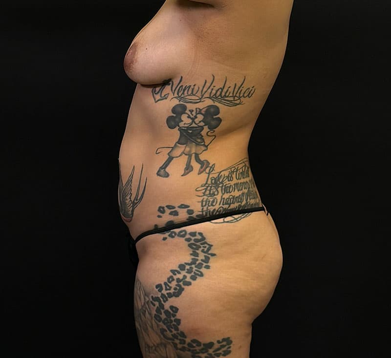 High-Definition Liposuction 360 Before - Patient 423426 - Left View