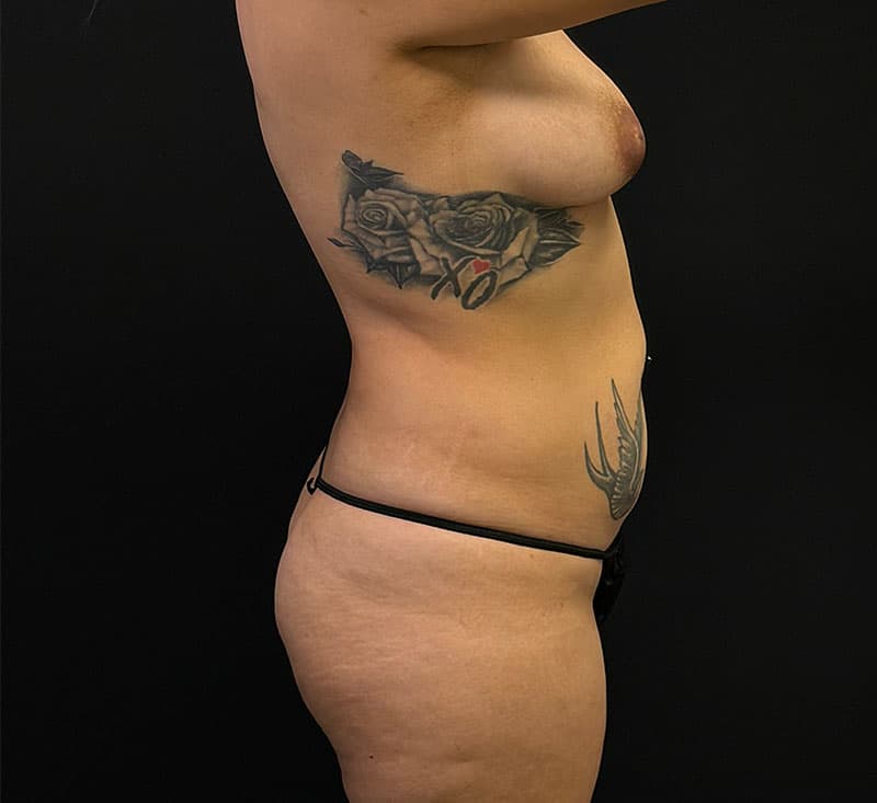 High-Definition Liposuction 360 Before - Patient 423426 - Right View