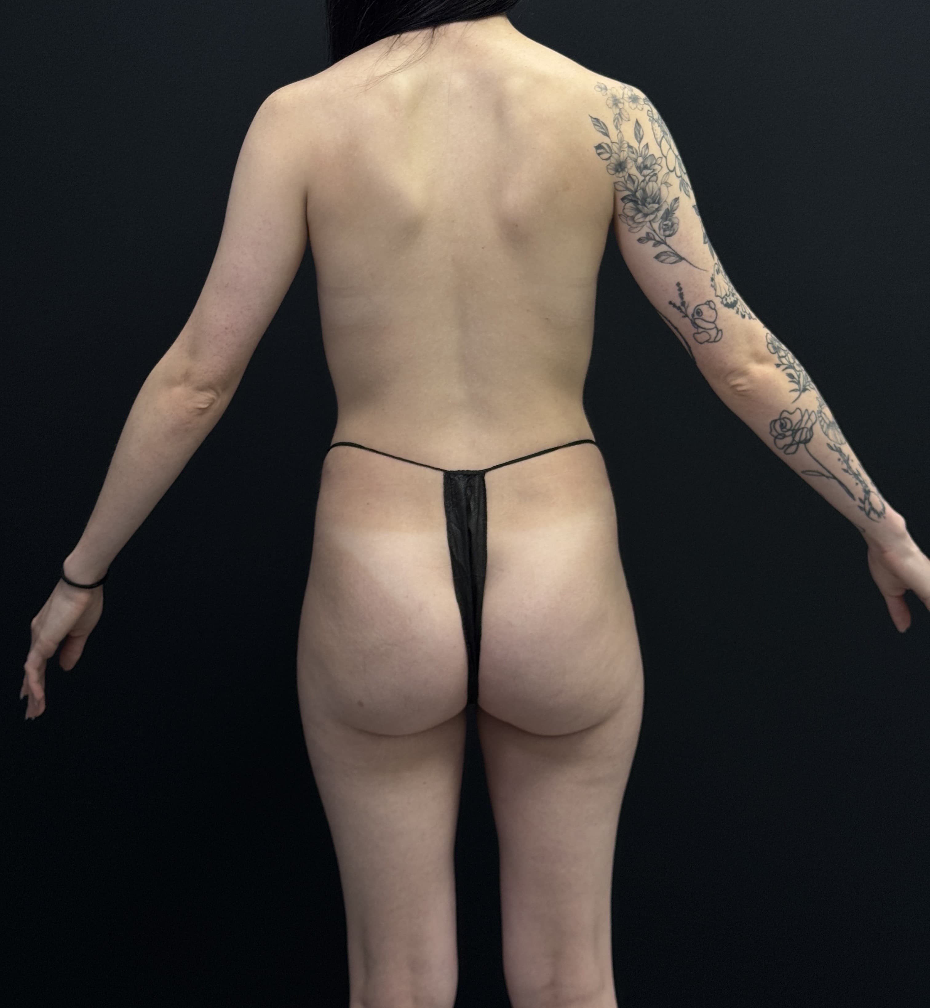 High-Definition Liposuction 360 After - Patient 4434 - Back View