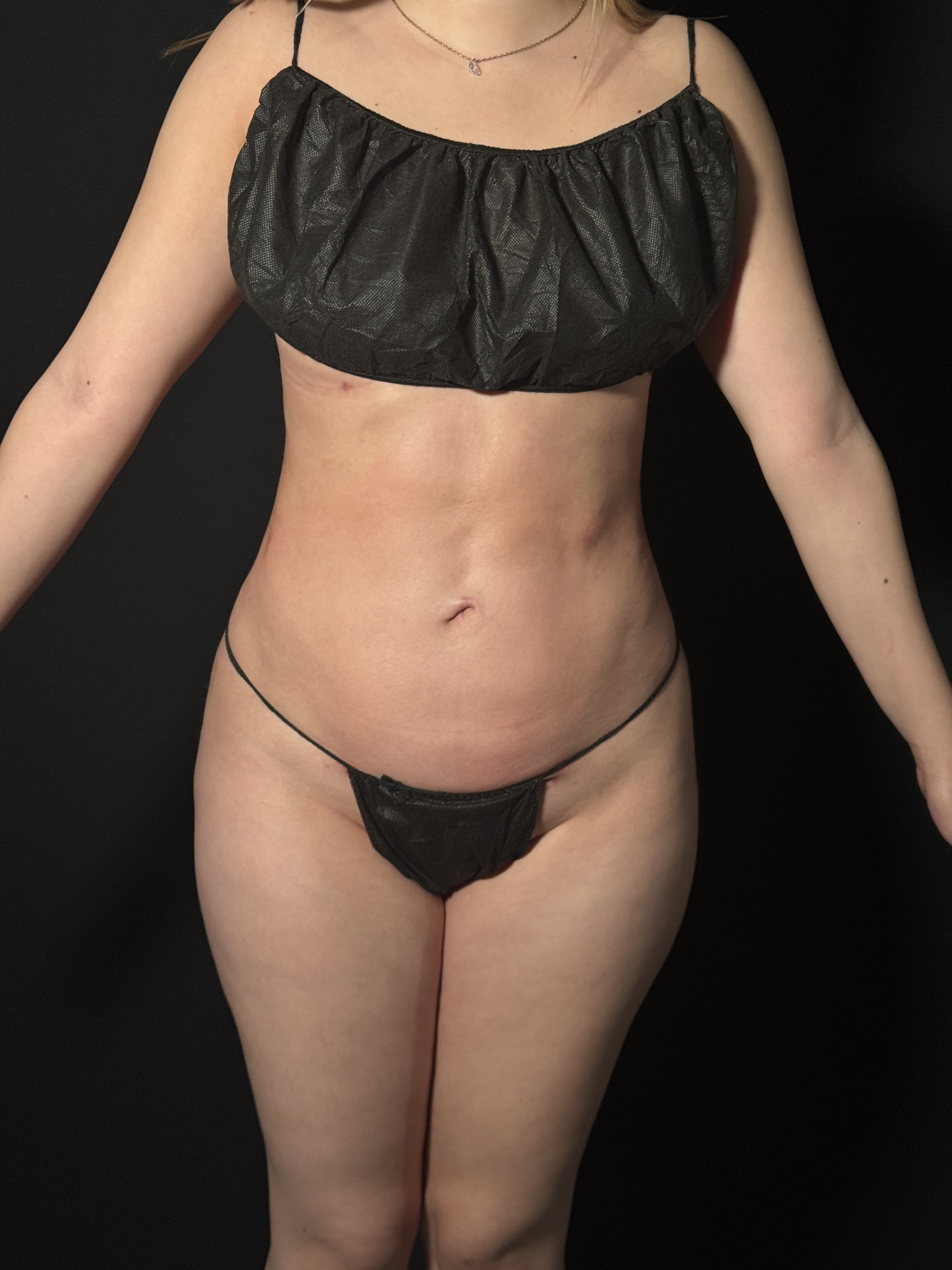 Brazilian Butt Lift After - Patient 4895 - Front View