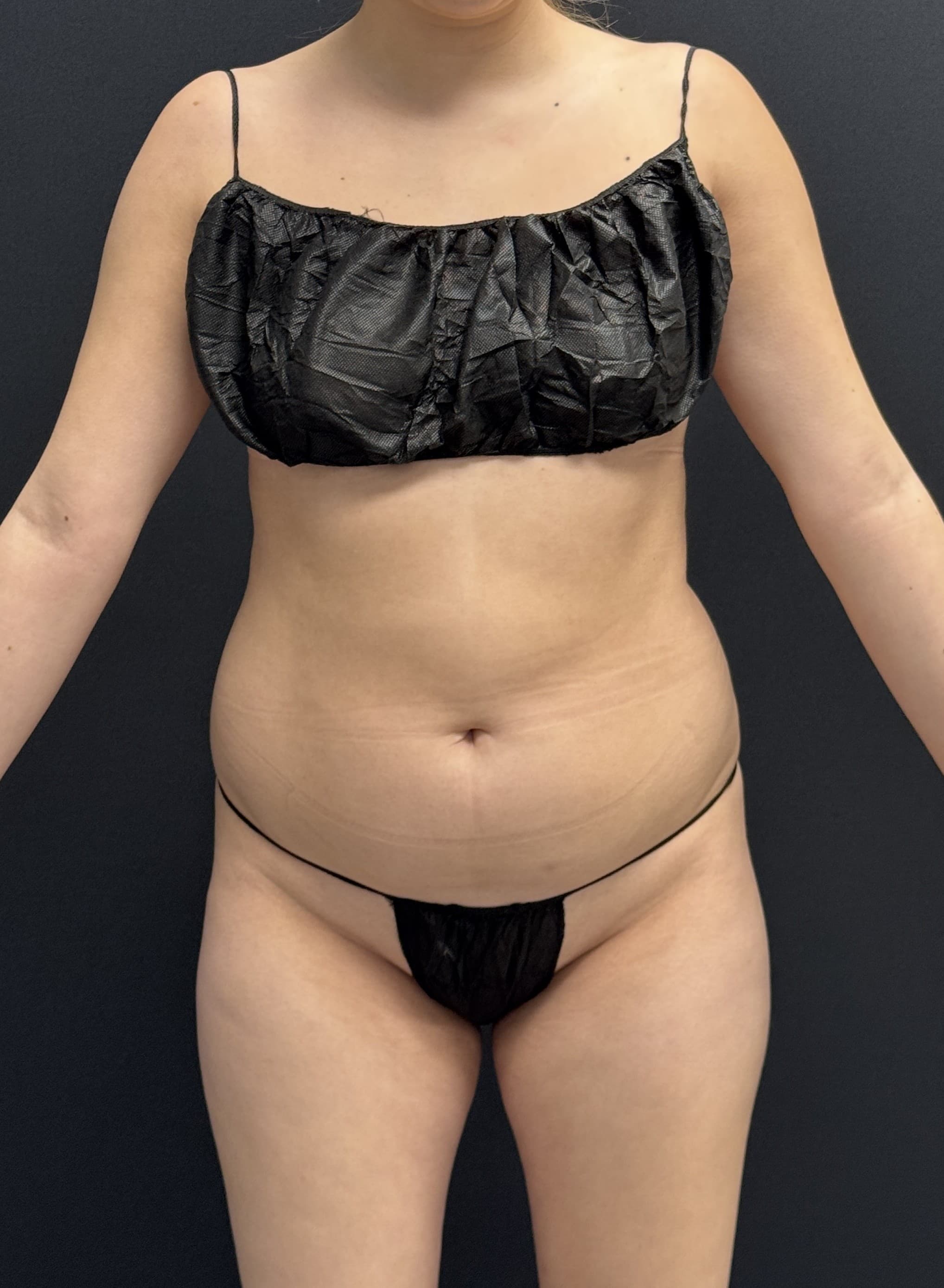 Brazilian Butt Lift Before - Patient 4895 - Front View