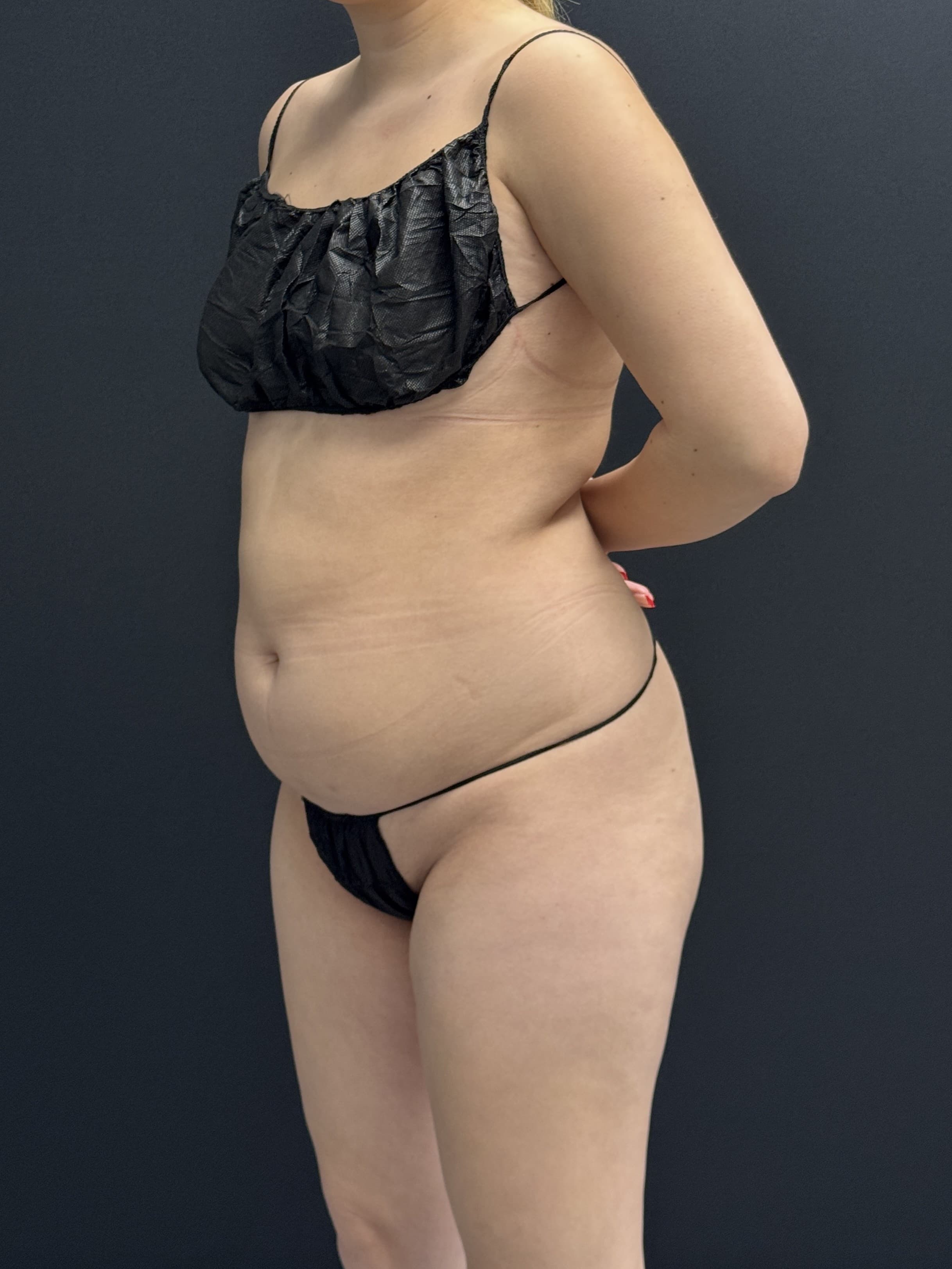 Brazilian Butt Lift Before - Patient 4895 - Front Left View