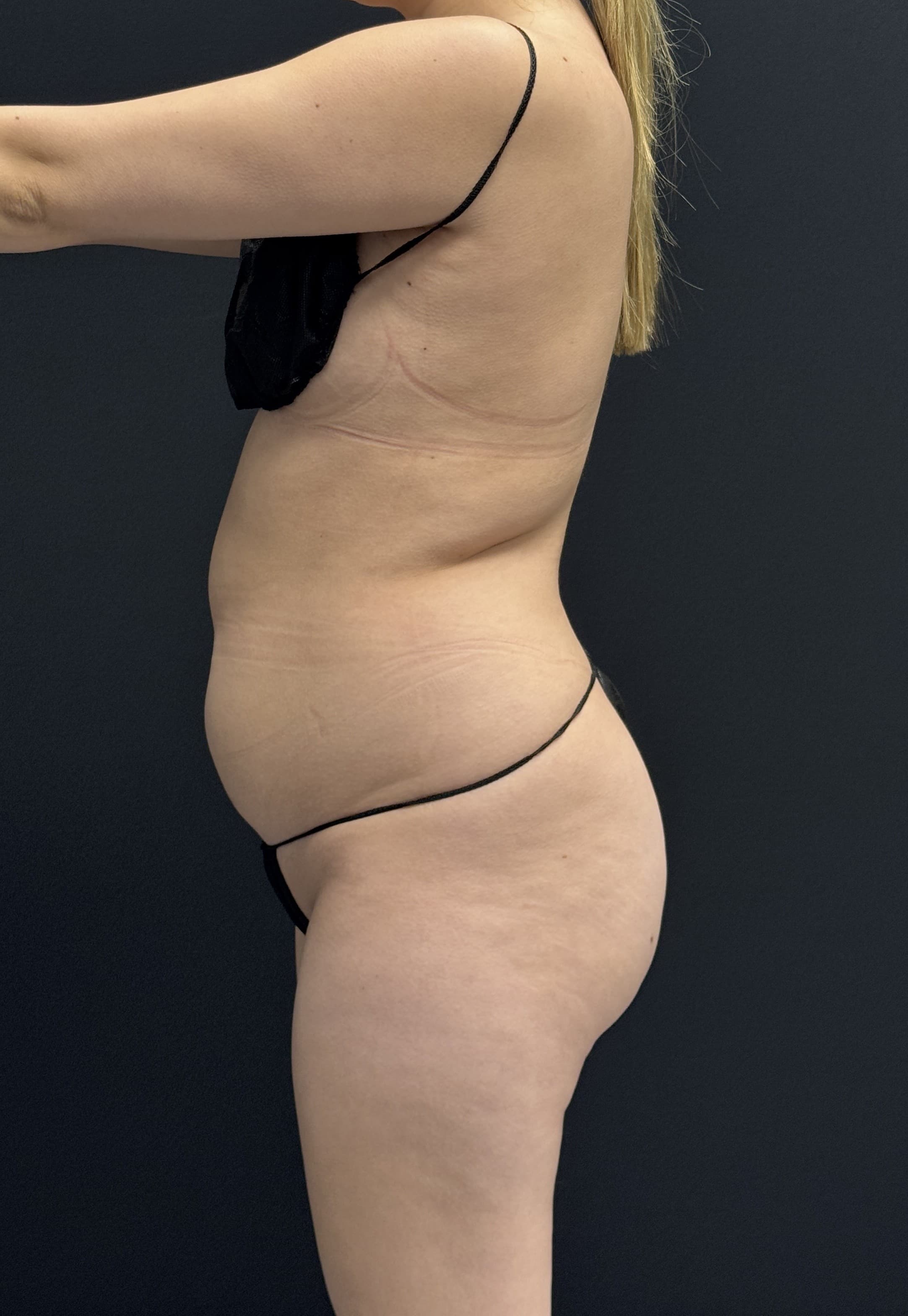 Brazilian Butt Lift Before - Patient 4895 - Left View