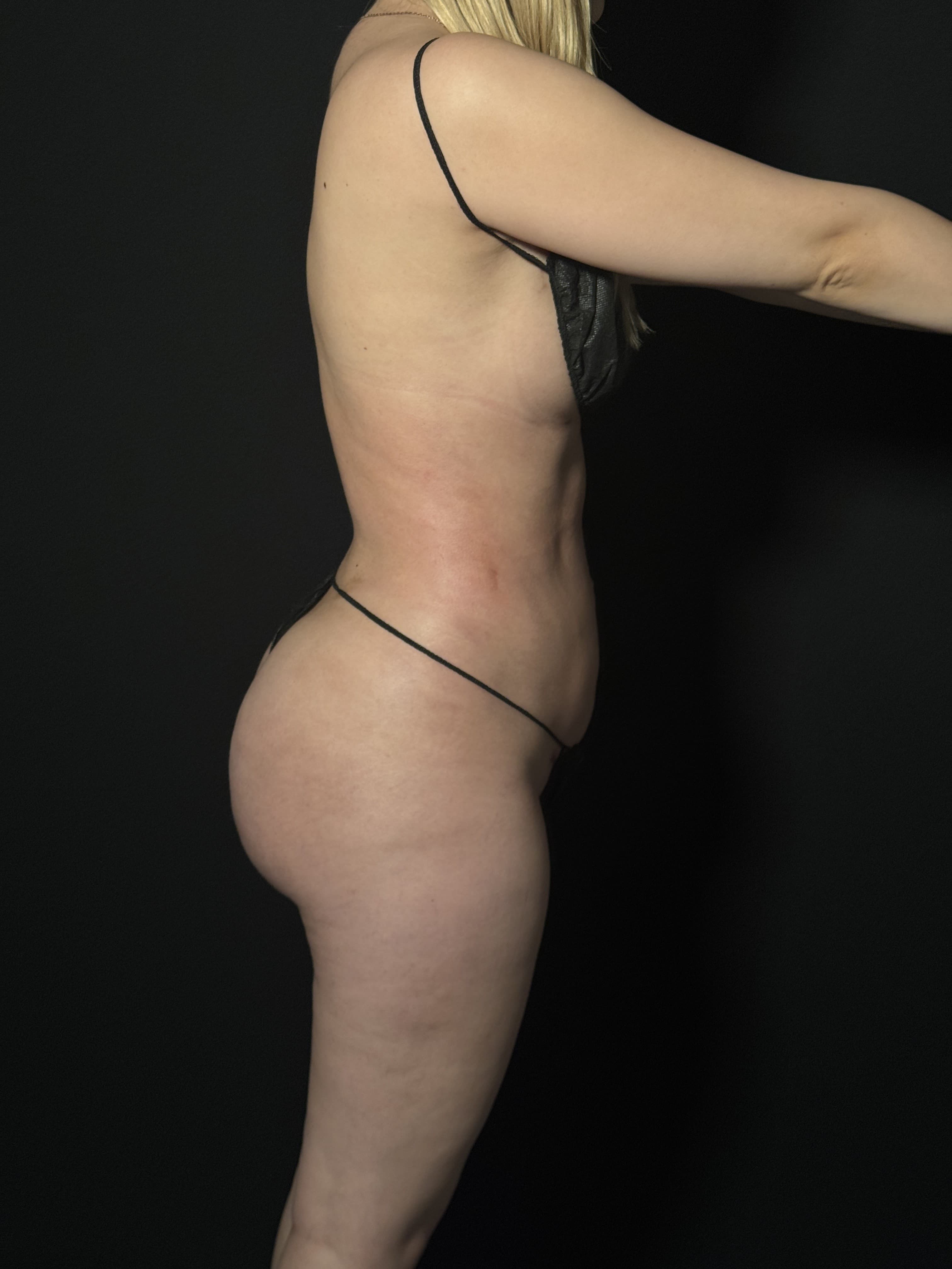 Brazilian Butt Lift After - Patient 4895 - Right View