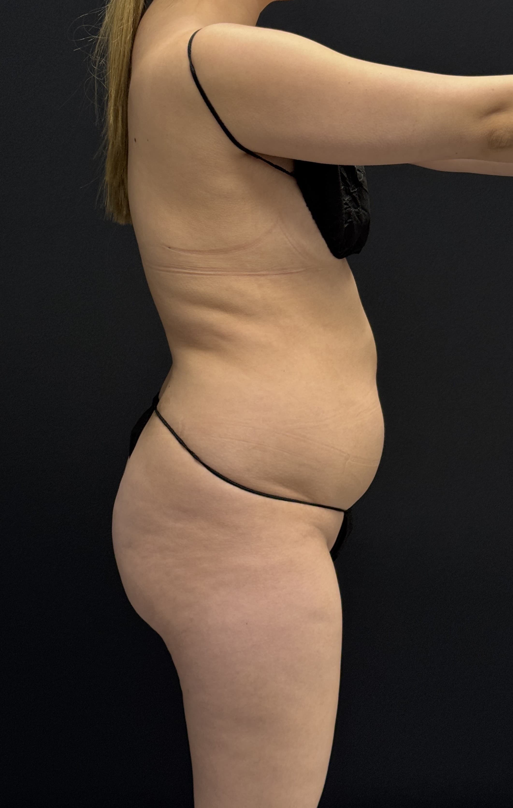 Brazilian Butt Lift Before - Patient 4895 - Right View