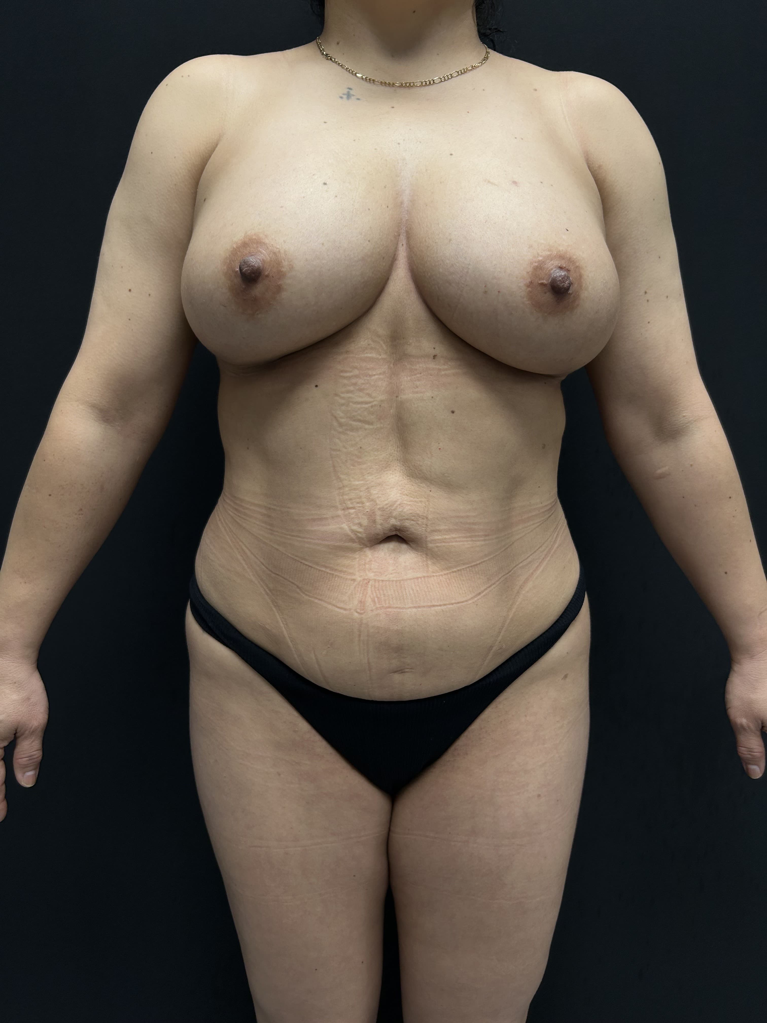 Fat Transfer After - Patient 5625 - Front View