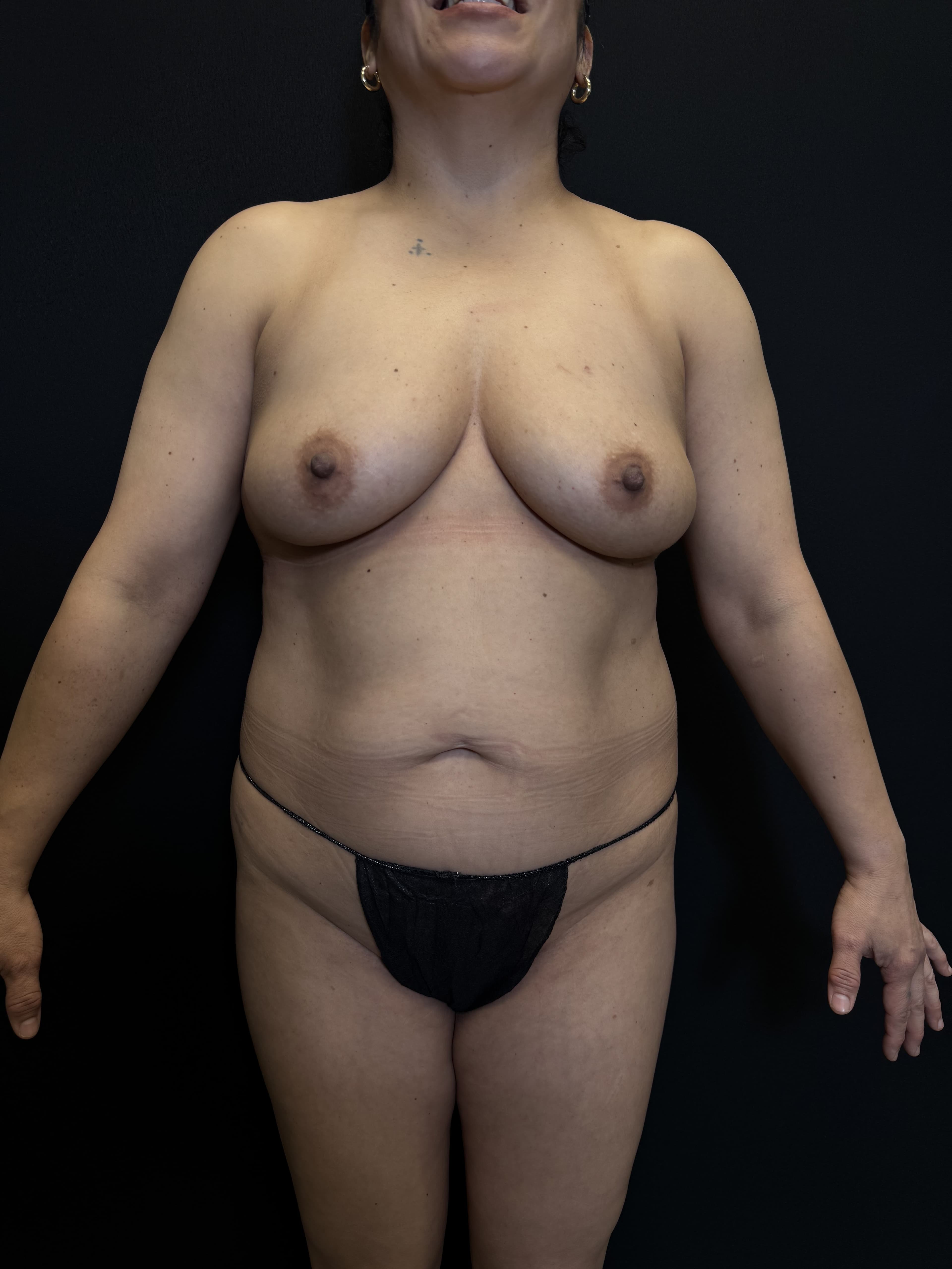 Fat Transfer Before - Patient 5625 - Front View