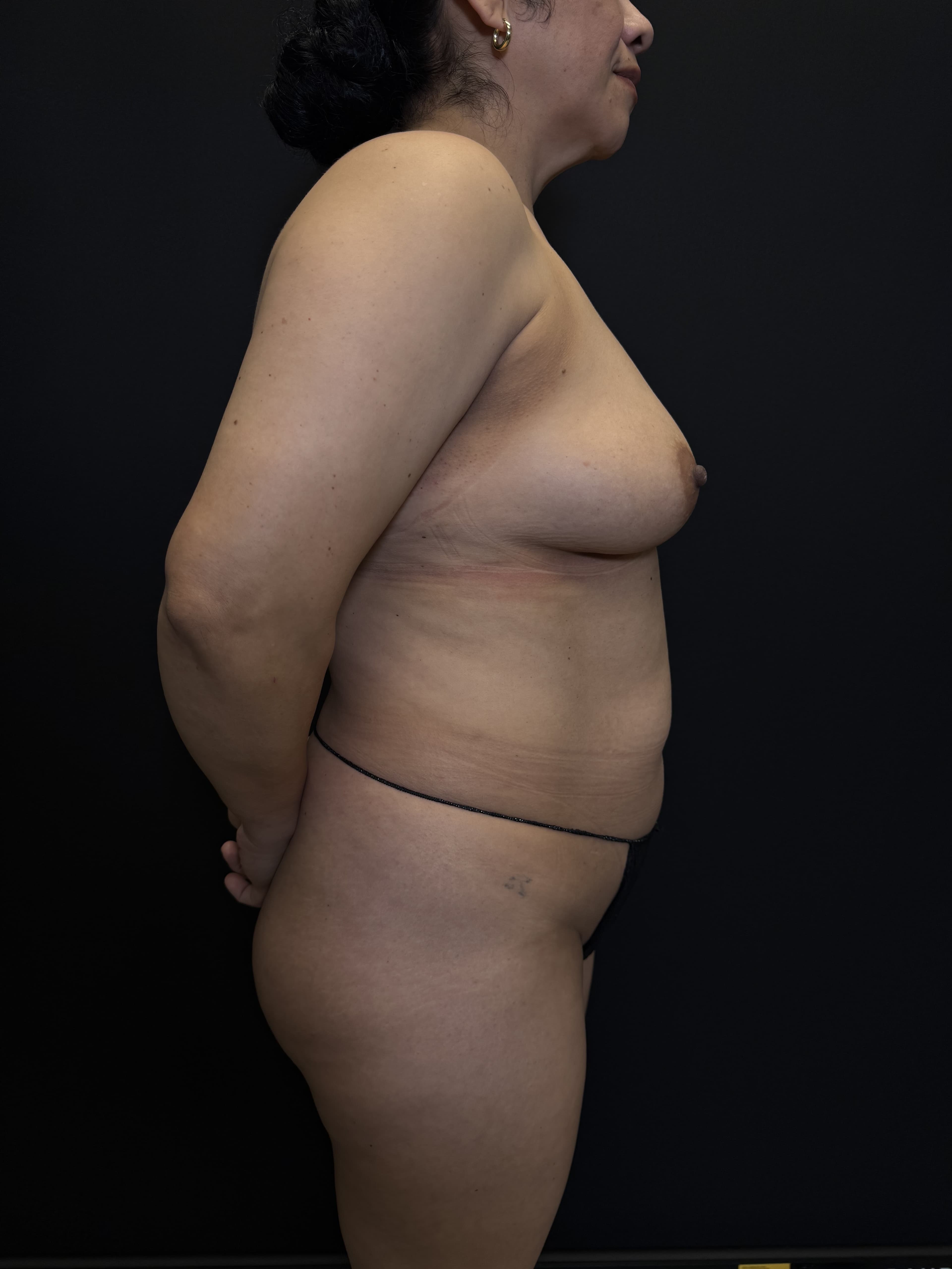 Fat Transfer Before - Patient 5625 - Right View