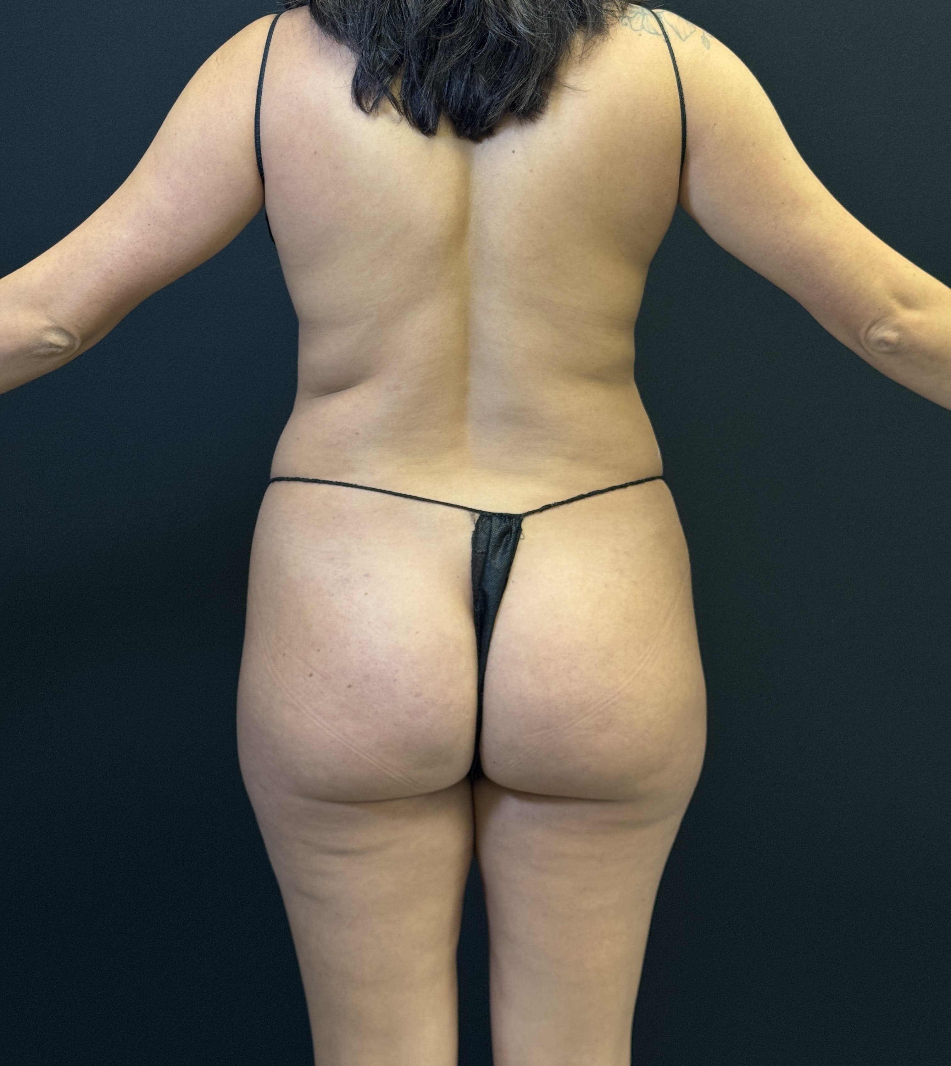 High-Definition Liposuction 360 Before - Patient 1282 - Back View