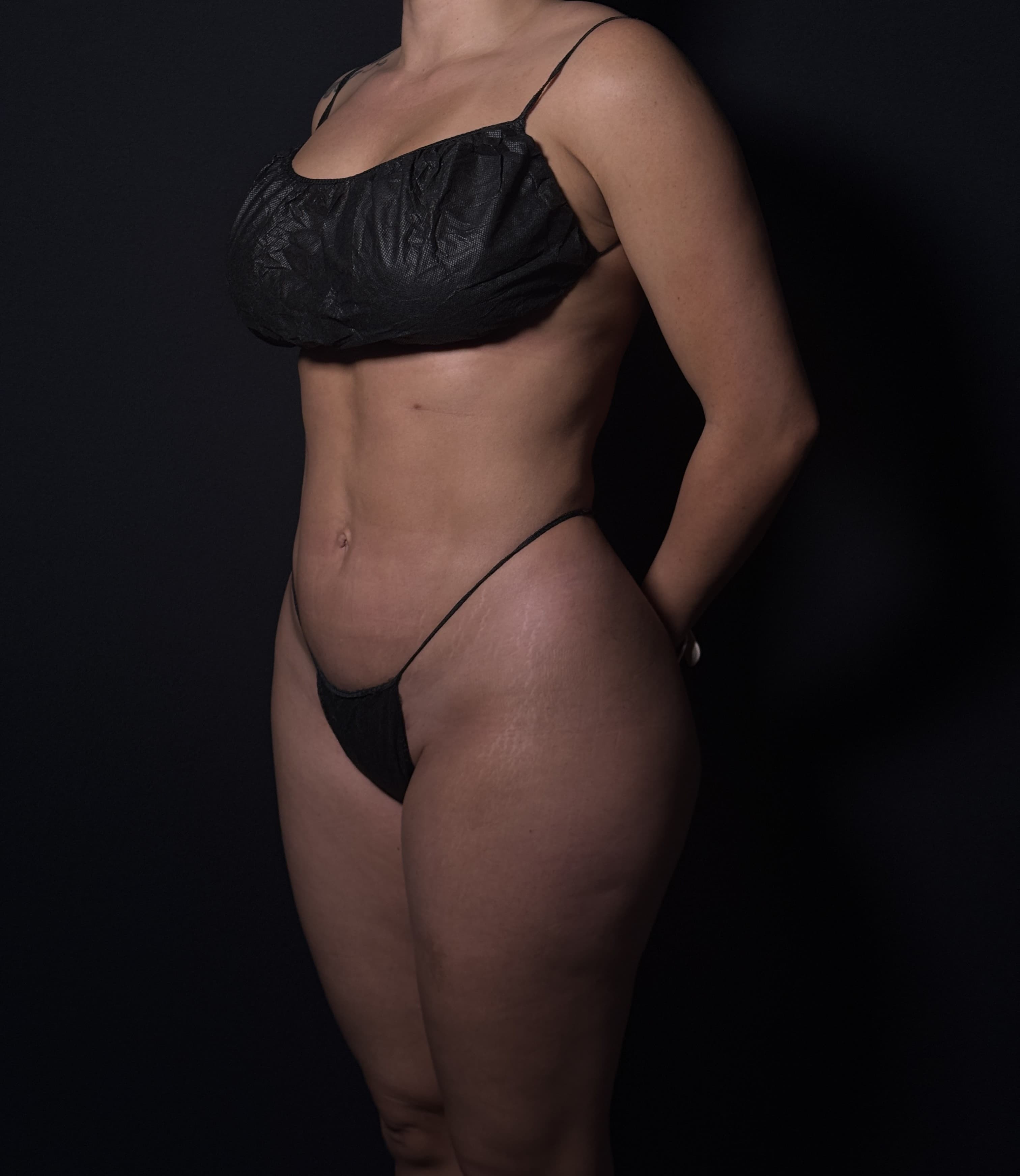 High-Definition Liposuction 360 After - Patient 1282 - Front Left View