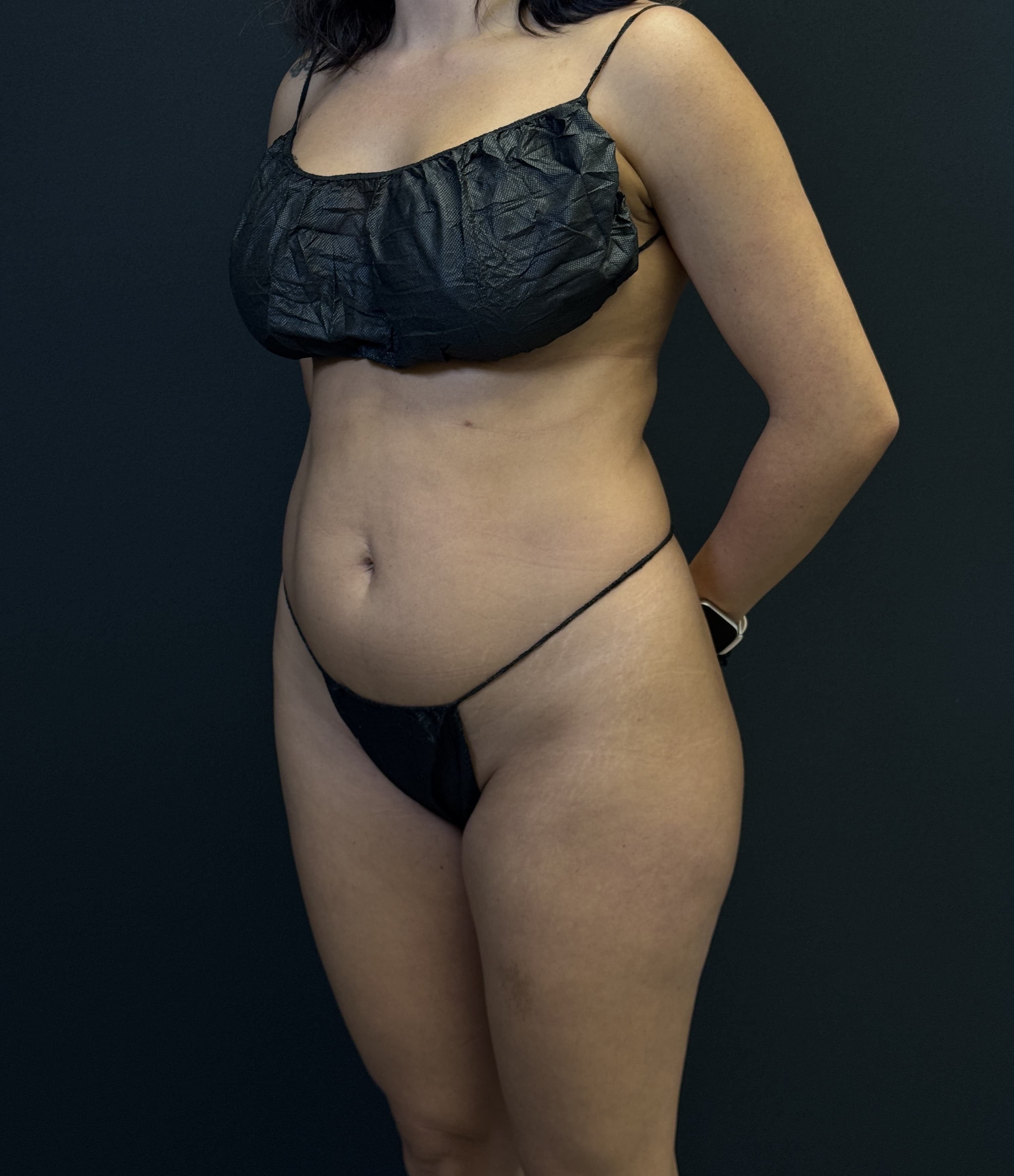 High-Definition Liposuction 360 Before - Patient 1282 - Front Left View
