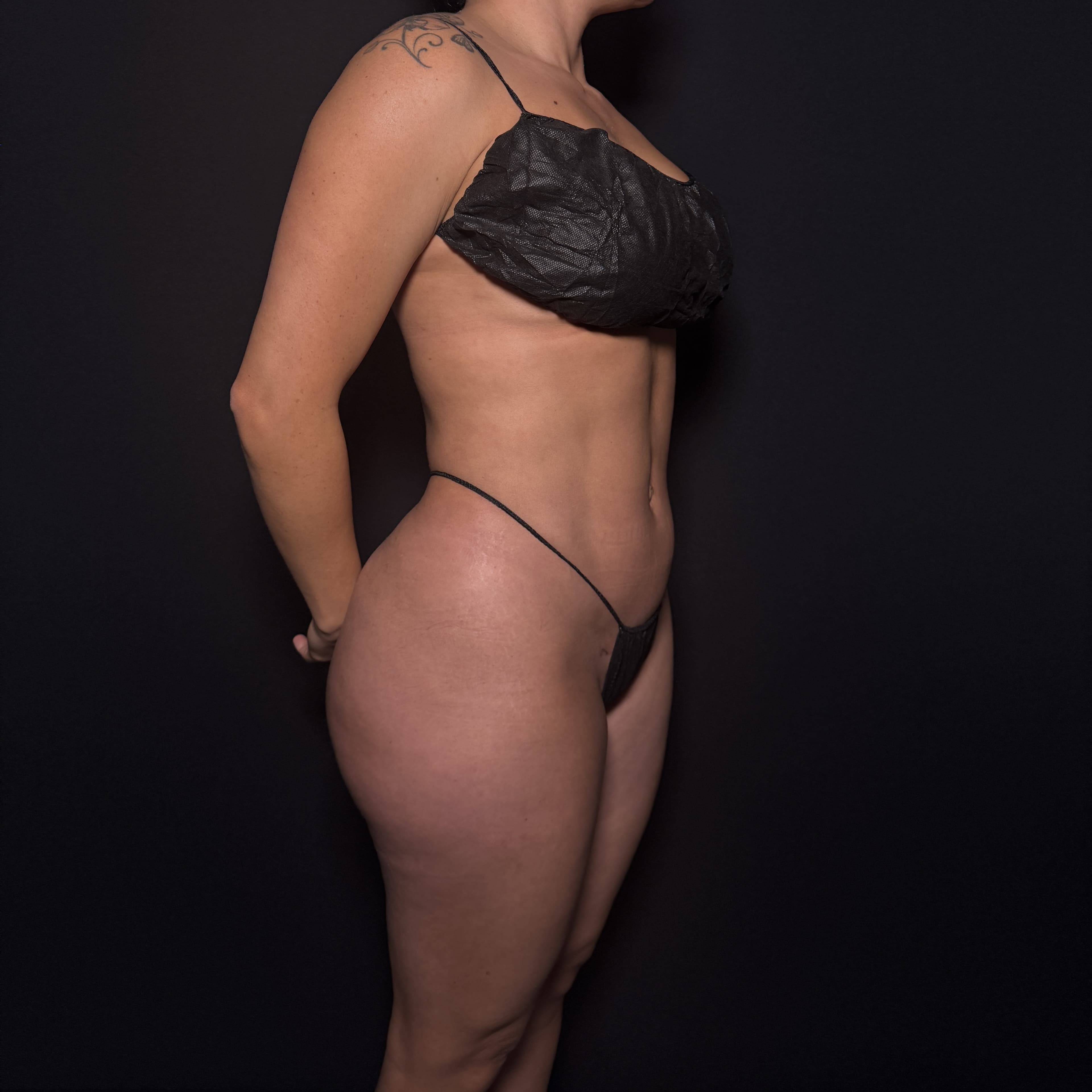 High-Definition Liposuction 360 After - Patient 1282 - Front Right View