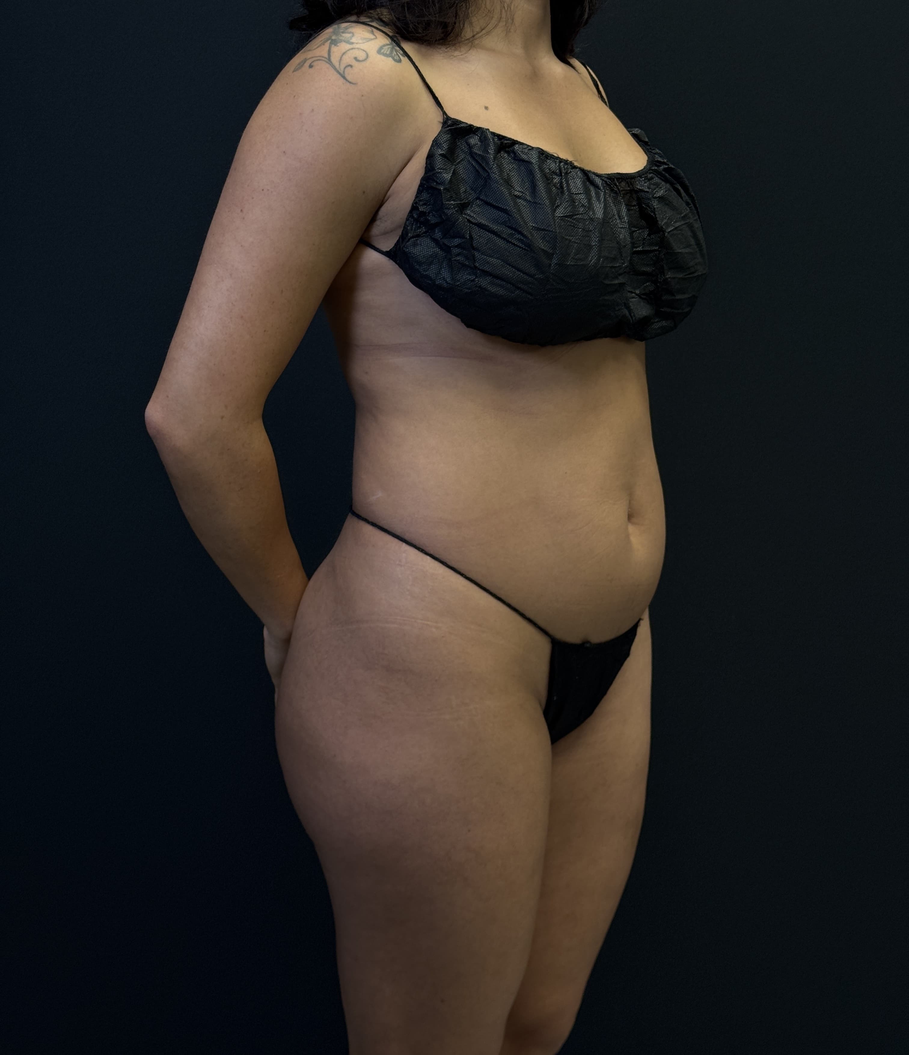High-Definition Liposuction 360 Before - Patient 1282 - Front Right View
